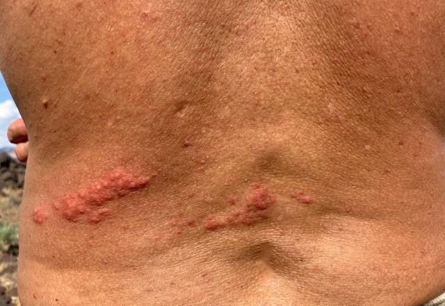 A shingles rash on the lower left back