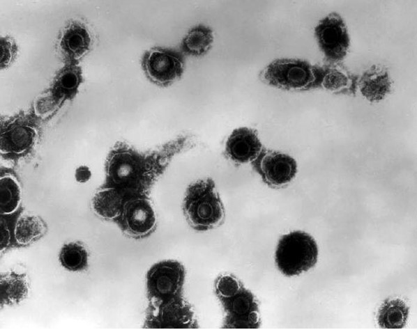 Electron-micrograph image of Varicella Zoster virus (VZV), the virus that causes chickenpox. Shingles is the reactivation of VZV.